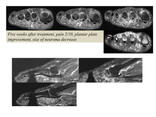 Five weeks after treatment, pain 2/10, plantar plate
improvement, size of neuroma decrease
 