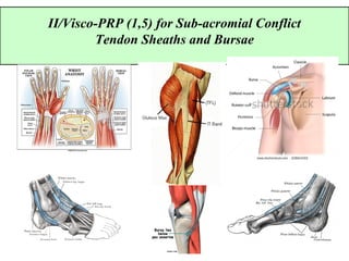 II/Visco-PRP (1,5) for Sub-acromial Conflict
Tendon Sheaths and Bursae
 