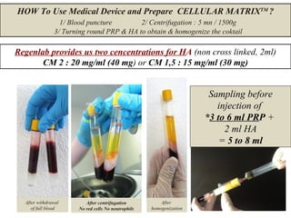HOW To Use Medical Device and Prepare CELLULAR MATRIXTM
?
1/ Blood puncture 2/ Centrifugation : 5 mn / 1500g
3/ Turning round PRP & HA to obtain & homogenize the coktail
After withdrawal
of full blood
After centrifugation
No red cells No neutrophils
After
homogenization
HA
PRP
Sampling before
injection of
*3 to 6 ml PRP +
2 ml HA
= 5 to 8 ml
Regenlab provides us two cencentrations for HA (non cross linked, 2ml)
CM 2 : 20 mg/ml (40 mg) or CM 1,5 : 15 mg/ml (30 mg)
 