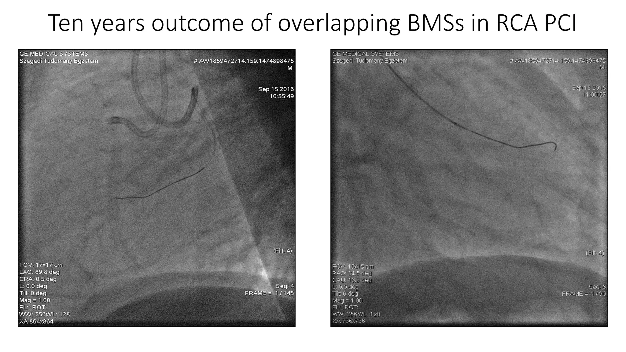 Ten years outcome of overlapping BMSs in RCA PCI
 