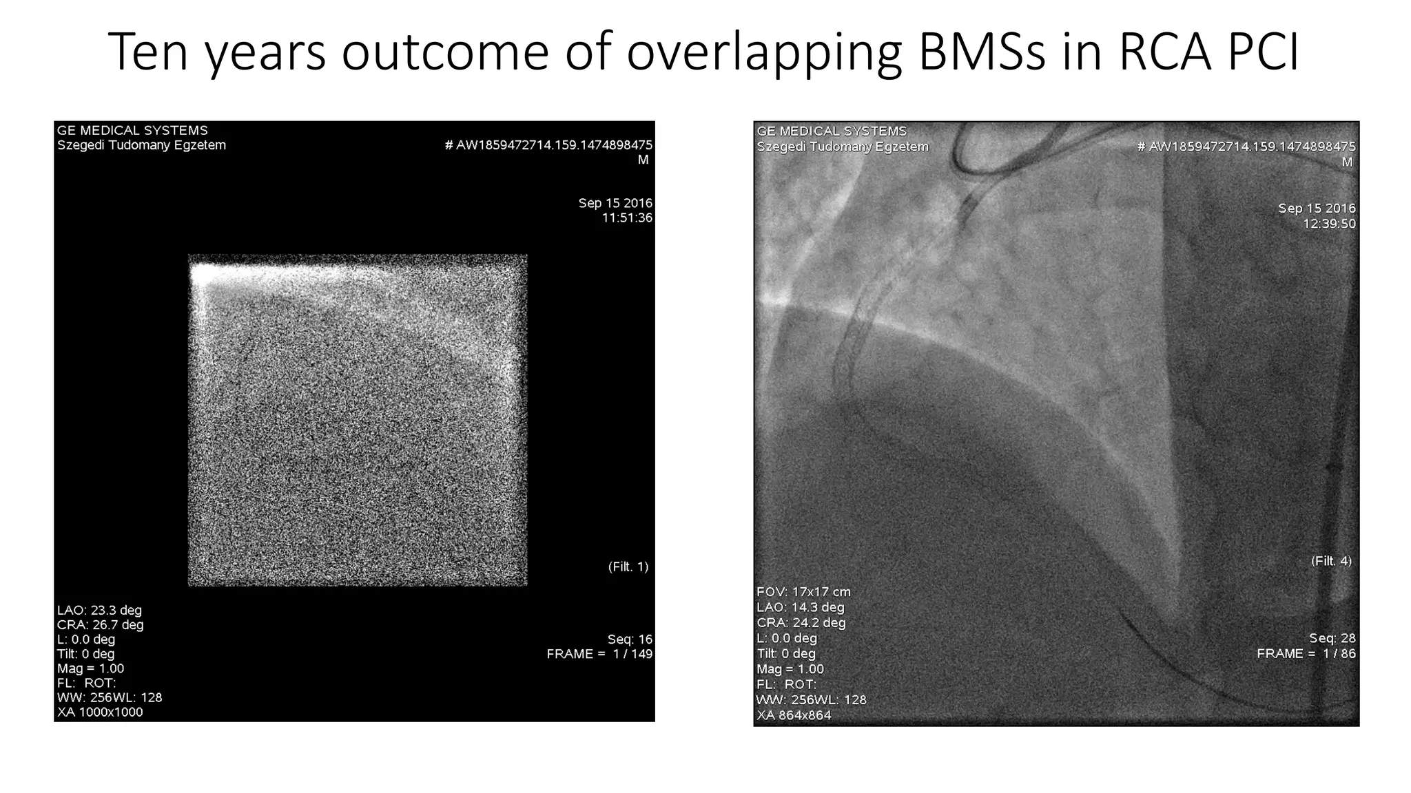 Ten years outcome of overlapping BMSs in RCA PCI
 