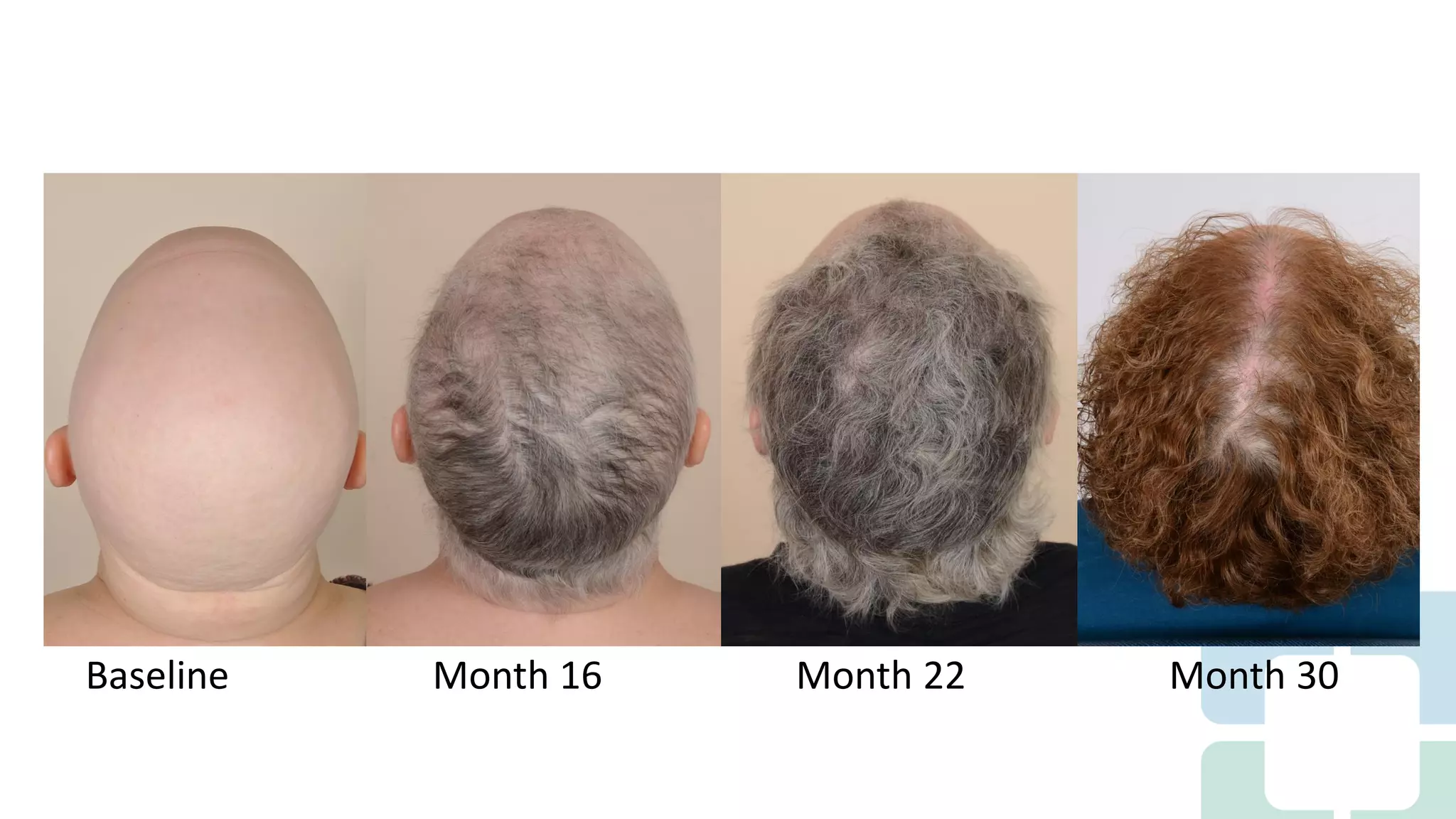 Long Term Treatment for Severe Alopecia Areata with Oral Tofacitinib ...