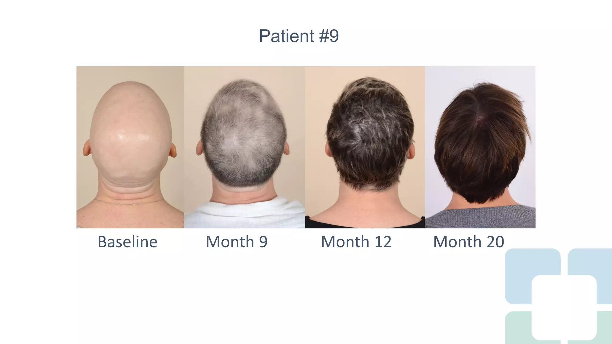 Long Term Treatment for Severe Alopecia Areata with Oral Tofacitinib ...