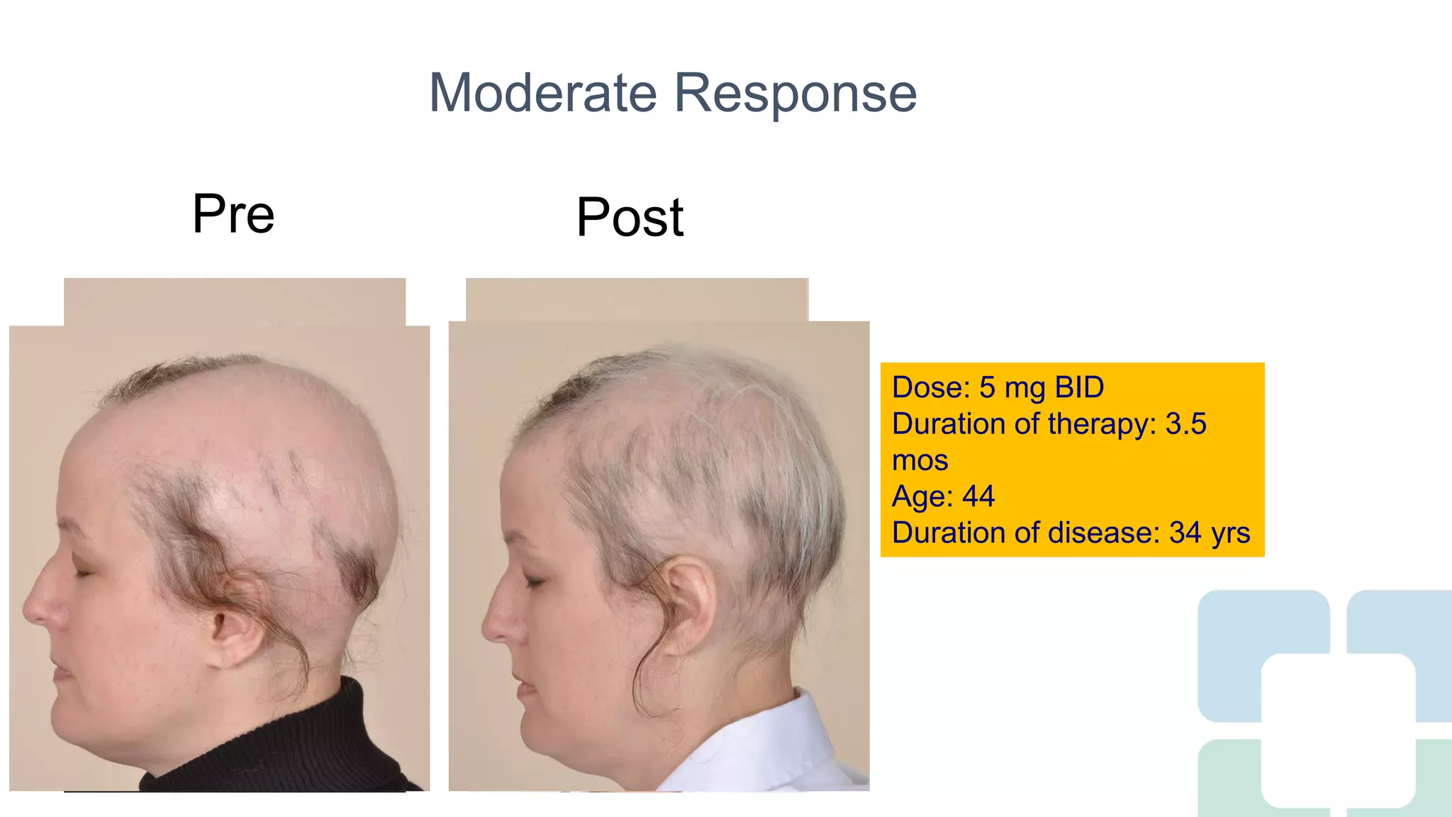 Long Term Treatment for Severe Alopecia Areata with Oral Tofacitinib ...