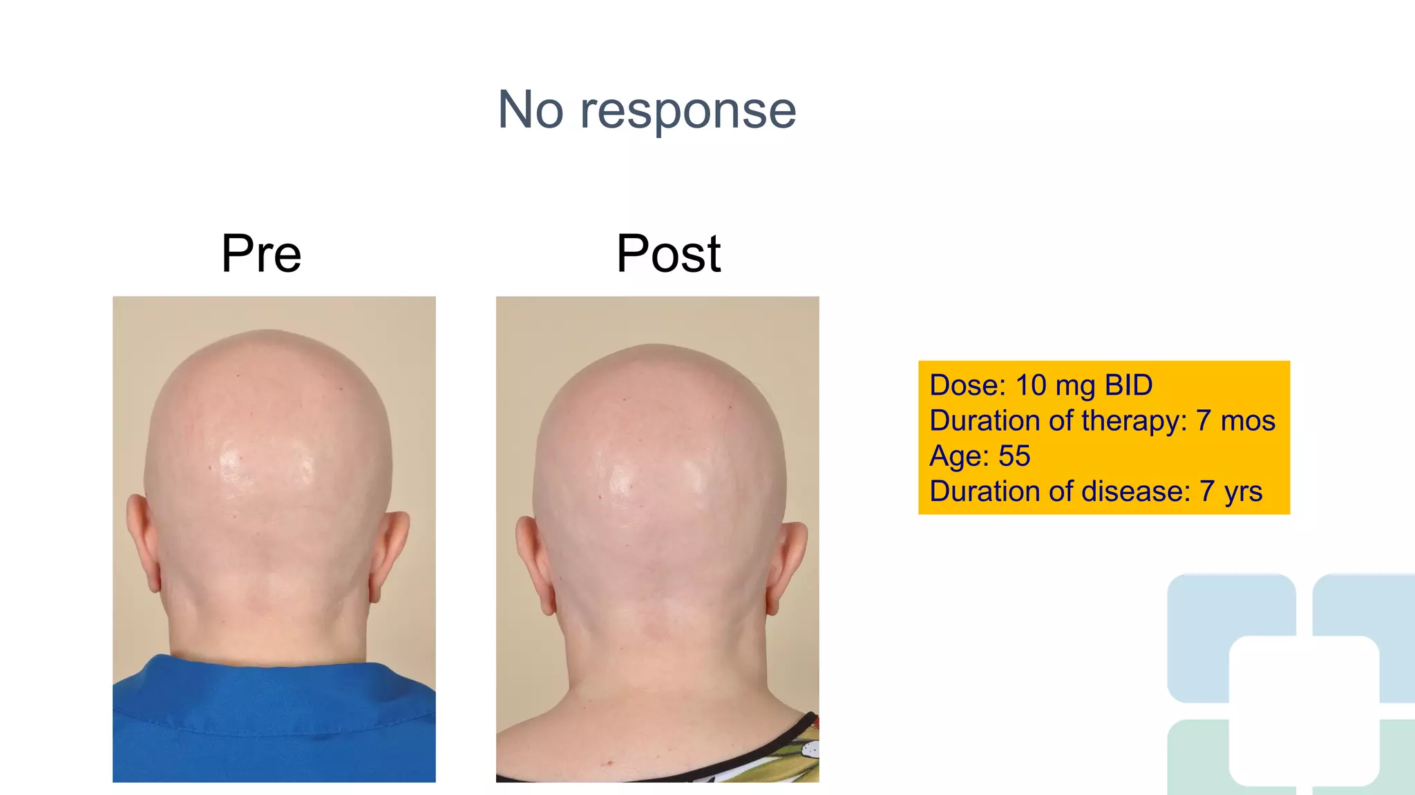 Long Term Treatment for Severe Alopecia Areata with Oral Tofacitinib ...