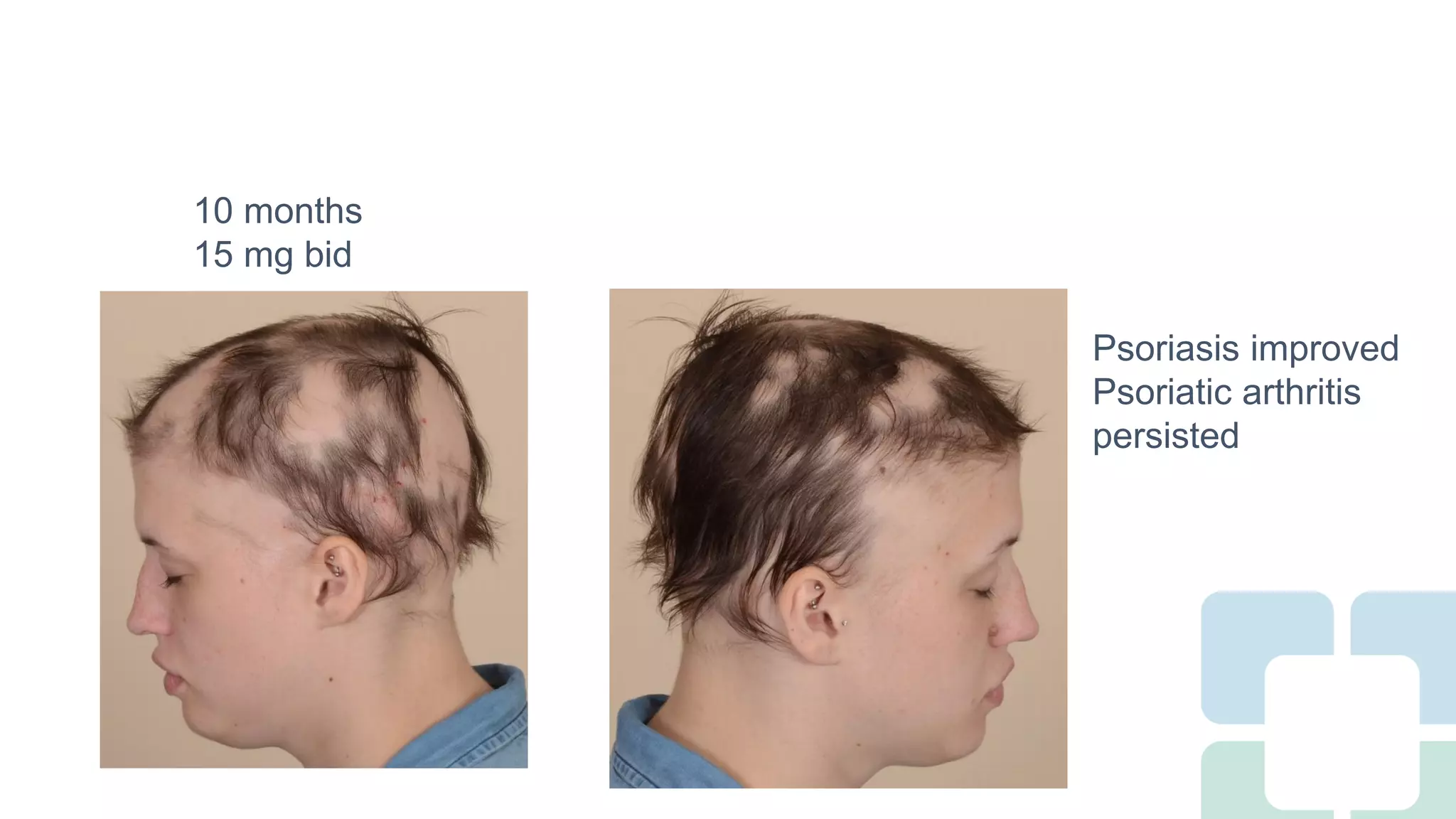 Long Term Treatment for Severe Alopecia Areata with Oral Tofacitinib ...