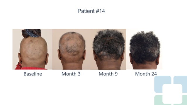 Long Term Treatment for Severe Alopecia Areata with Oral Tofacitinib ...