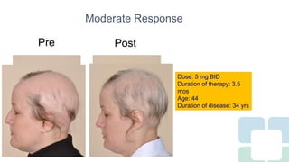 Long Term Treatment for Severe Alopecia Areata with Oral Tofacitinib ...