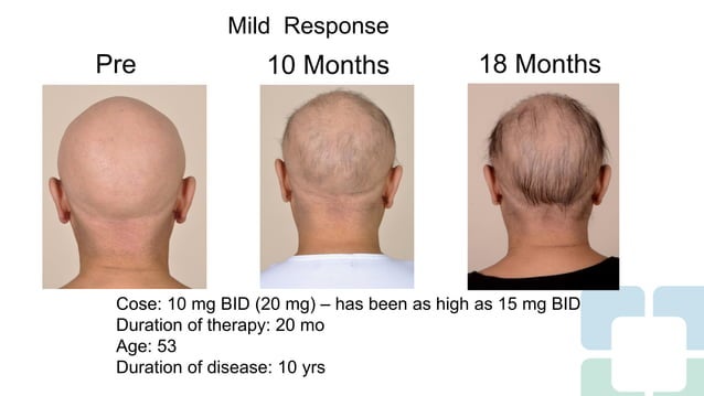 Long Term Treatment for Severe Alopecia Areata with Oral Tofacitinib ...