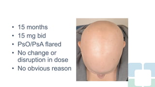 Long Term Treatment for Severe Alopecia Areata with Oral Tofacitinib ...
