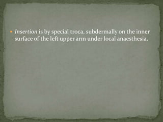  Insertion is by special troca, subdermally on the inner
surface of the left upper arm under local anaesthesia.
 