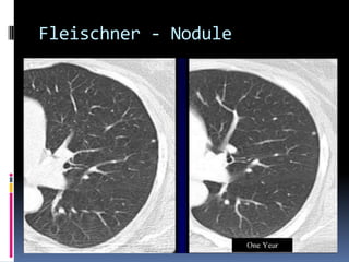 Fleischner - Nodule
 
