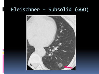 Fleischner – Subsolid (GGO)
 