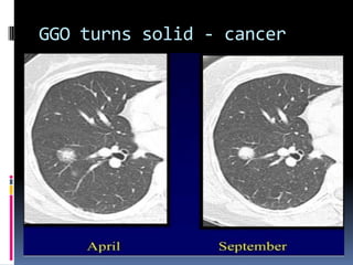 GGO turns solid - cancer
 
