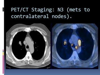 PET/CT Staging: N3 (mets to
contralateral nodes).
 