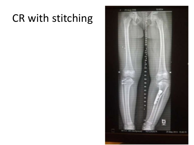Long bone measurement