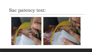 Sac patency test:
 
