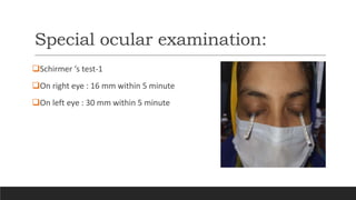 Special ocular examination:
Schirmer ‘s test-1
On right eye : 16 mm within 5 minute
On left eye : 30 mm within 5 minute
 