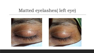 Matted eyelashes( left eye)
 