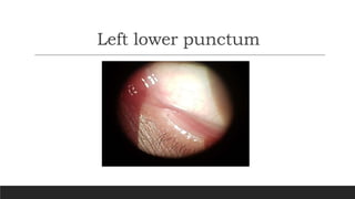 Left lower punctum
 