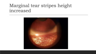 Marginal tear stripes height
increased
 