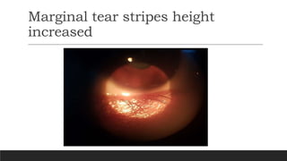 Marginal tear stripes height
increased
 