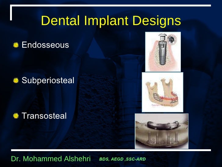 Longitudinal Studies Of Dental Implant Systems 1