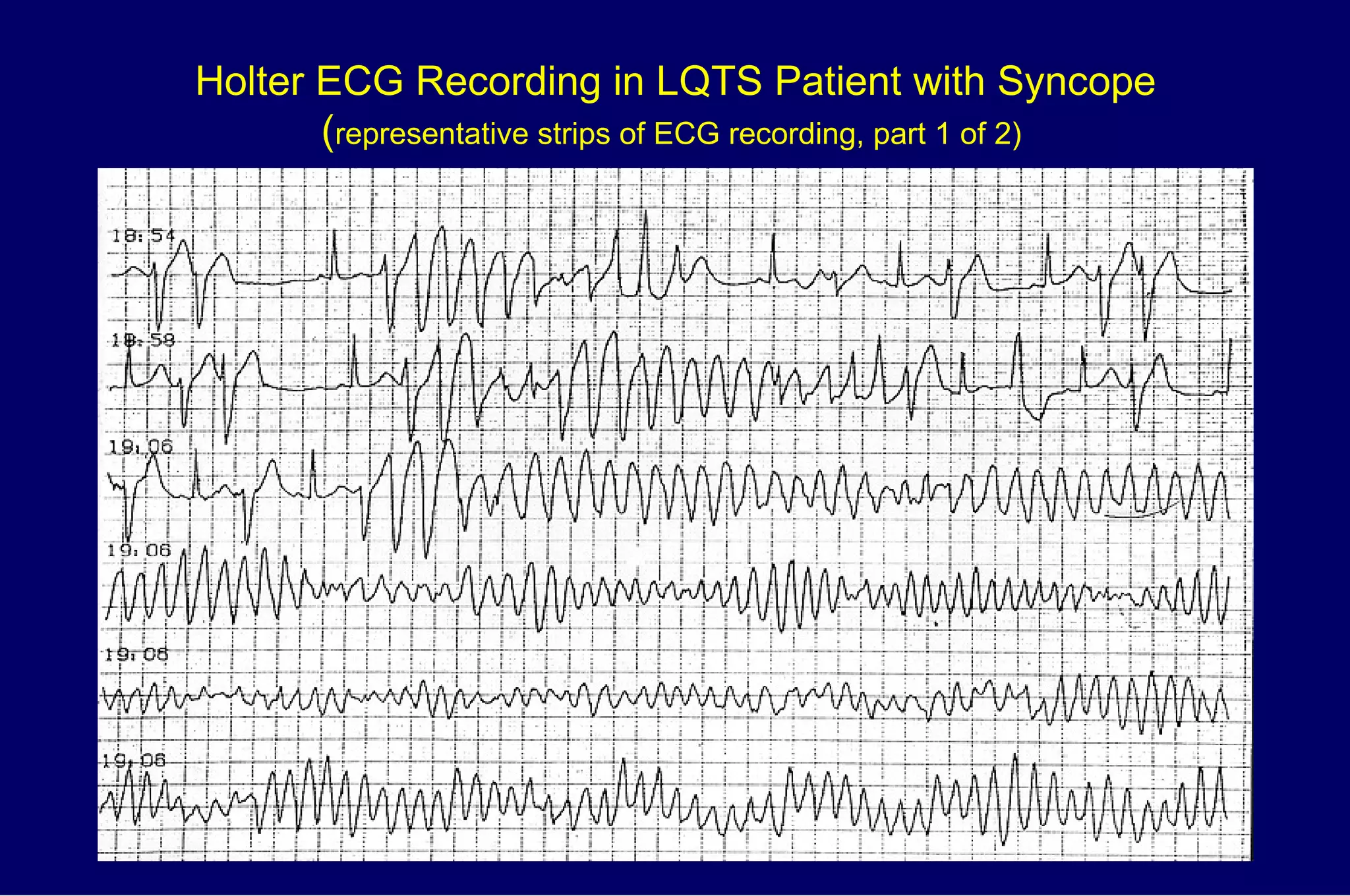 Holter ECG Recording in LQTS Patient with Syncope ( representative strips of ECG recording, part 1 of 2)   