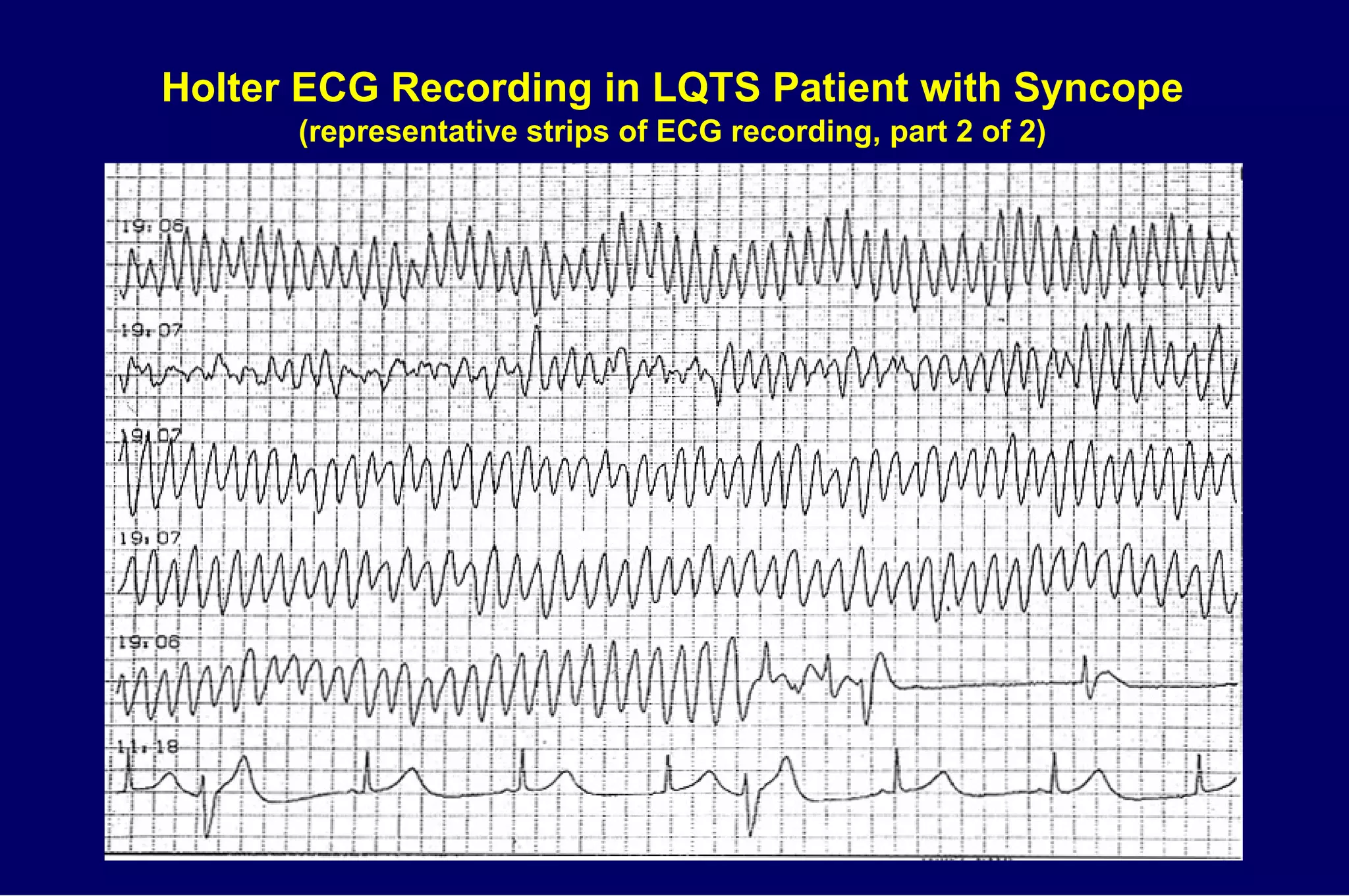 Holter ECG Recording in LQTS Patient with Syncope   (representative strips of ECG recording, part 2 of 2) 
