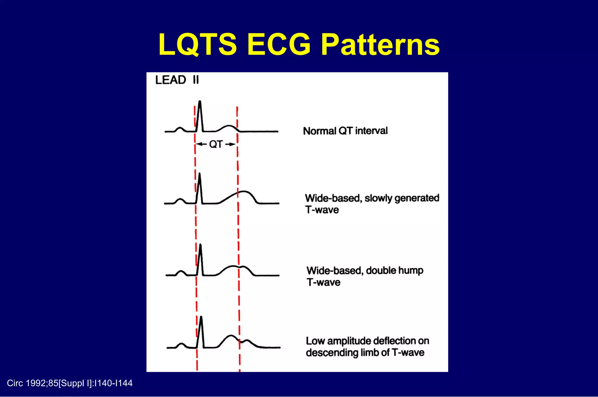 LQTS ECG Patterns Circ 1992;85[Suppl I]:I140-I144 