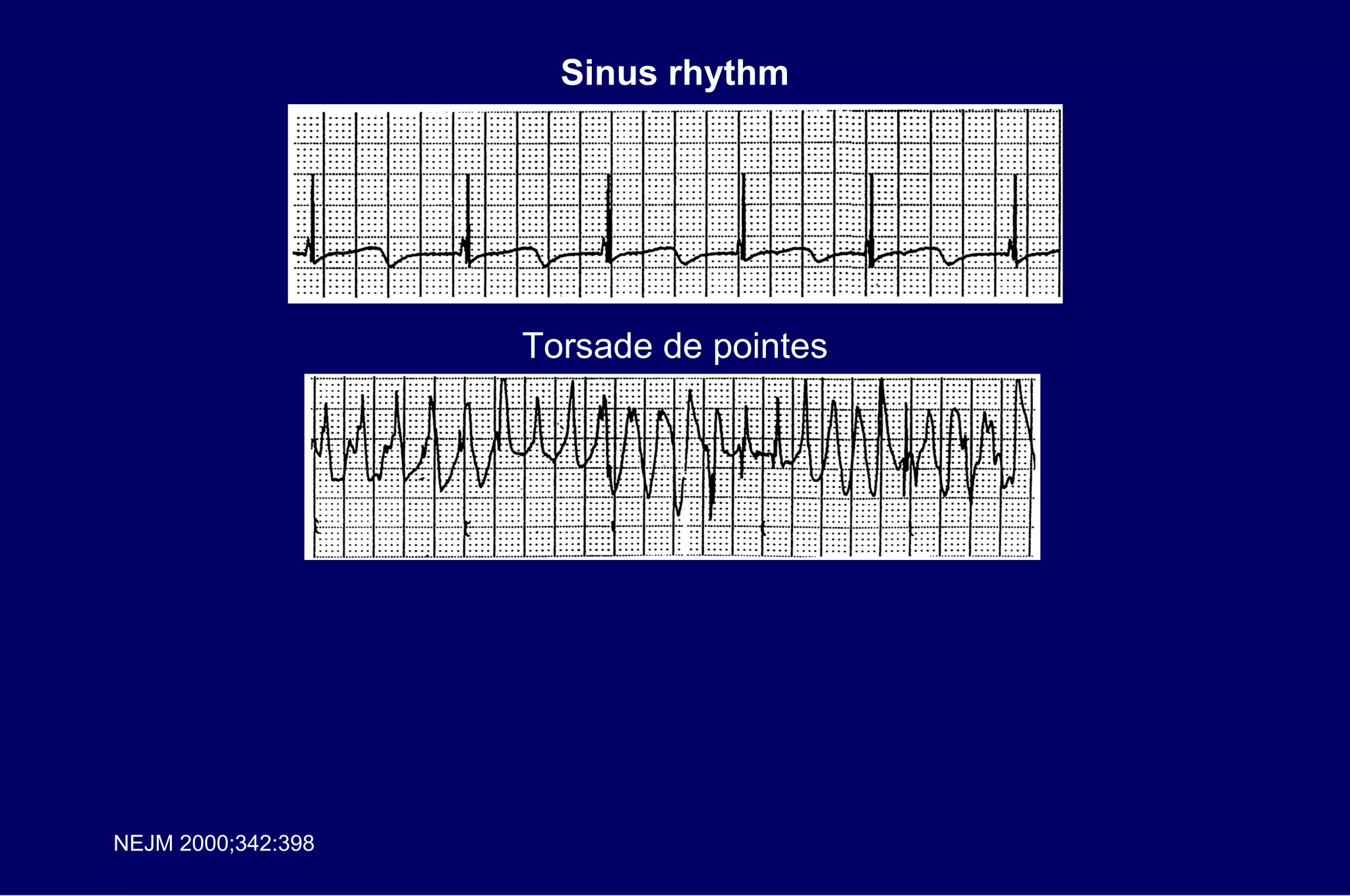 Sinus rhythm Torsade de pointes NEJM 2000;342:398 