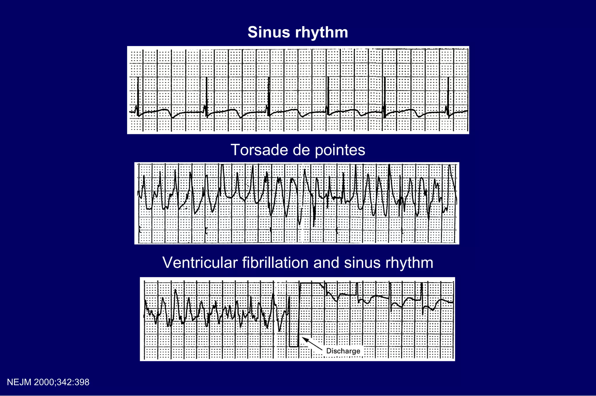 Sinus rhythm Torsade de pointes Ventricular fibrillation and sinus rhythm NEJM 2000;342:398 