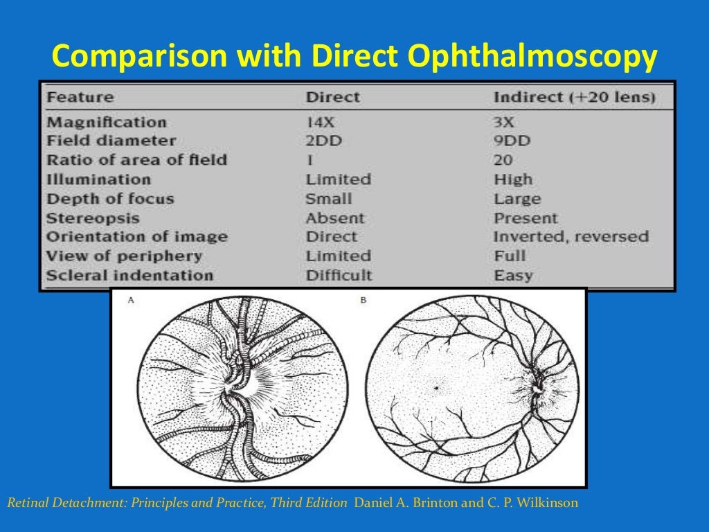 Looking deep into retina indirect ophthalmoscopy and fundus drawing
