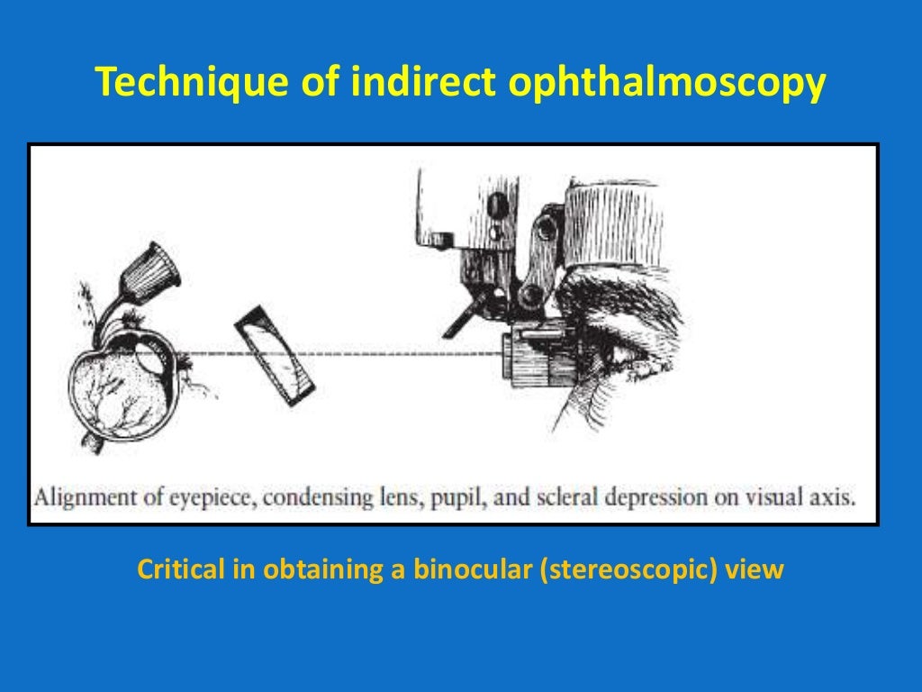 Looking deep into retina indirect ophthalmoscopy and fundus drawing