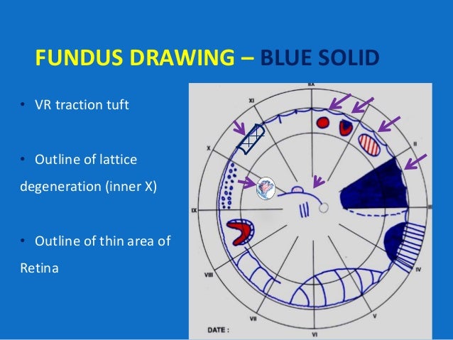 Fundus Drawing Chart