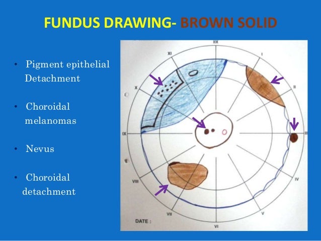 Modified Amsler Dubois Fundus Drawing Chart