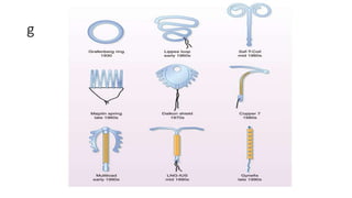 Loop (device orsystem) insertion during cesarean section | PPTX