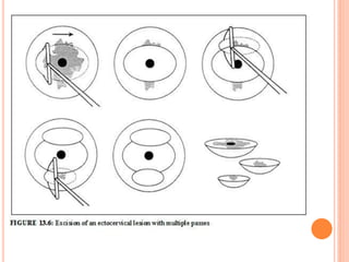 Loop electrosurgical excision procedure | PDF