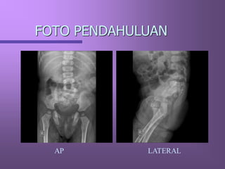 Loopografi Normal Radiologi LOOPOGRAFI.pdf