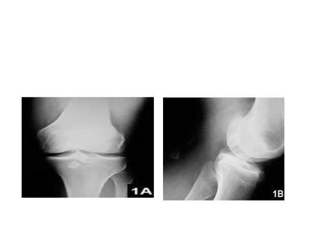 Loose Bodies In Knee