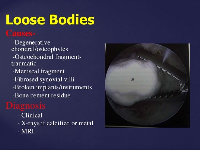 Loose Body Arthroscopy By Dr. Shekhar Srivastav