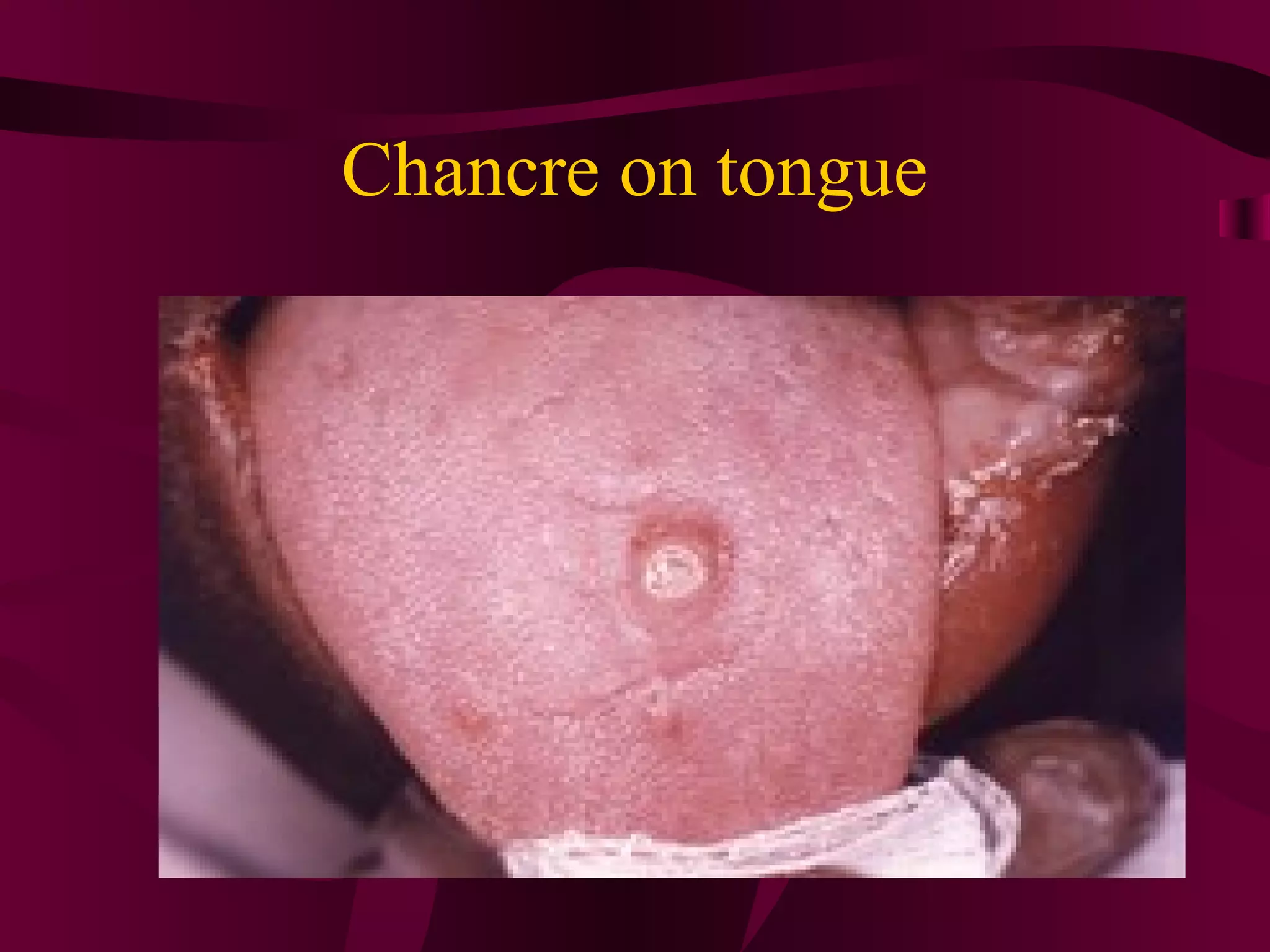 Chancre on tongue
 