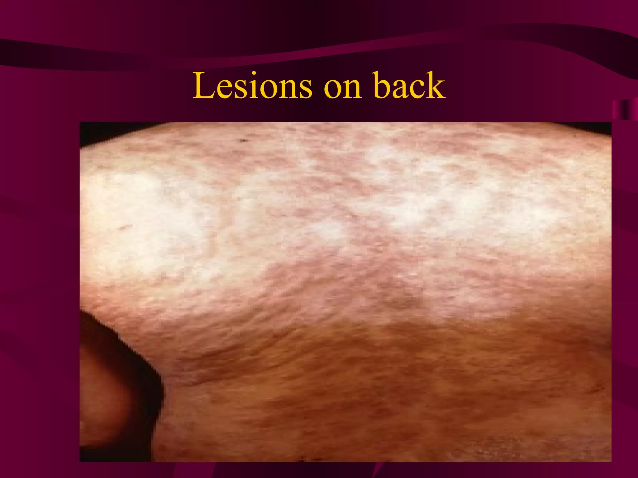 Lesions on back
 