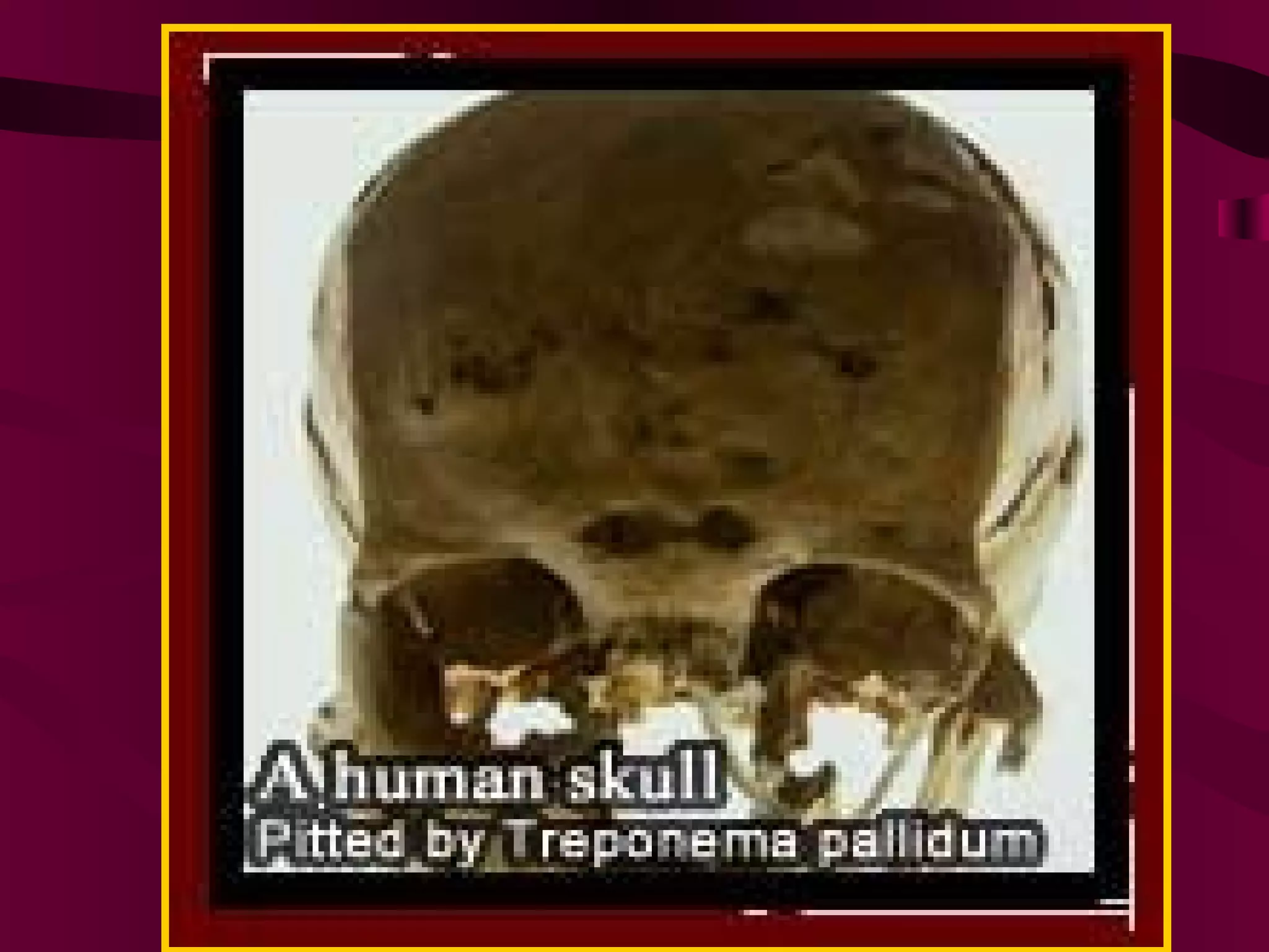 [Micro] syphilis