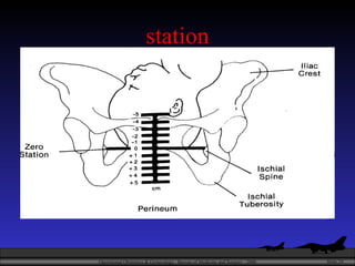 station SO assess following before any intervention 1)EFW-fundal height > 40 cm at this stage  is large baby 2)Degree of engagement 3)Position of the presenting part 4)Evidence of obstruction 5)Any pelvic mass 