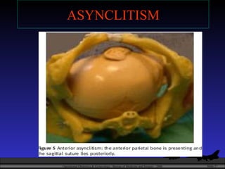 ASYNCLITISM 