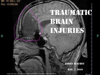 Traumatic  Brain Injuries LOREnteachey May, 7, 2010 Image used under a CC license from http://www.flickr.com/photos/lfamily/186532580/ 