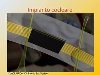 Impianto cocleare
è un orecchio artificiale elettronico che sostituisce la coclea
patologica inviando direttamente al nerv...