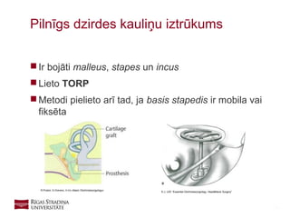 26
 Ir bojāti malleus, stapes un incus
 Lieto TORP
 Metodi pielieto arī tad, ja basis stapedis ir mobila vai
fiksēta
Pilnīgs dzirdes kauliņu iztrūkums
R.Probst, G.Grevers, H.Iro «Basic Otorhinolaryngology»
K.J. LEE “Essential Otorhinolaryngology. Head&Neck Surgery”
 