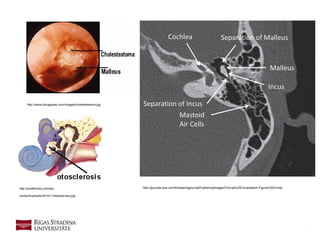 6
http://www.chicagoear.com/images/cholesteatoma.jpg
http://journals.lww.com/thehearingjournal/PublishingImages/Clinical%20Consultation-Figure%202.bmphttp://audifonoss.com/wp-
content/uploads/2014/11/otosclerosis.jpg
 